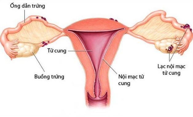 Bệnh lạc nội mạc tử cung là một trong những nguyên nhân khiến phụ nữ có nguy cơ chửa ngoài tử cung.