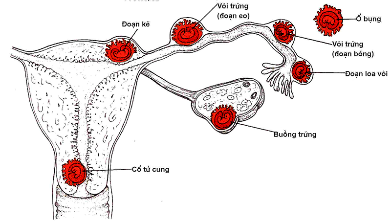 Chửa ngoài dạ con là như thế nào? Một số vị trí của thai ngoài dạ con