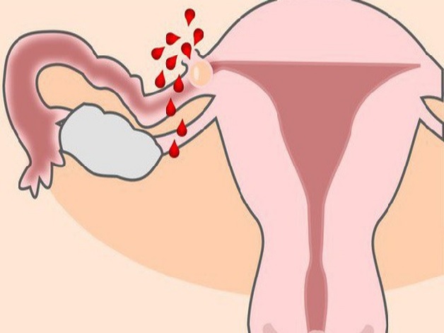 Chửa ngoài dạ con là tình trạng nhiều chị em gặp phải