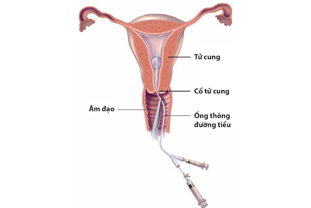 Chụp X quang vòi trứng là một kỹ thuật giúp các bác sĩ quan sát và nắm được tình trạng vòi trứng của phụ nữ.