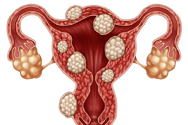 Đa nhân xơ tử cung là căn bệnh thường gặp ở chị em phụ nữ