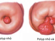 5 dấu hiệu polyp cổ tử cung điển hình nhất chị em nên lưu ý