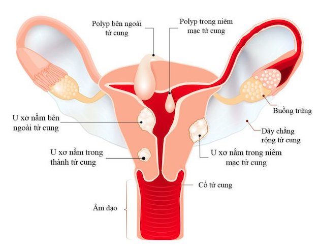 Nhân xơ tử cung nhỏ bản chất là một khối u tế bào cơ trơn, nhỏ hơn 30 mm, nằm trong tử cung.