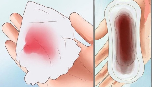 Xuất huyết âm đạo là một trong dấu hiệu của polyp tử cung