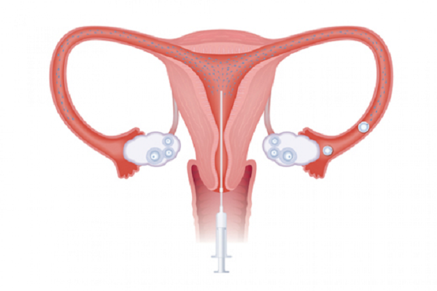 Nhiều chị em phụ nữ thắc mắc, liệu phẫu thuật u xơ tử cung có nguy hiểm không