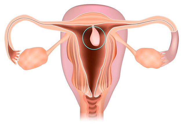 Polyp cổ tử cung có tự rụng không là câu hỏi của nhiều chị em phụ nữ. Đây là căn bệnh rất phổ biến trong độ tuổi sinh sản của phụ nữ