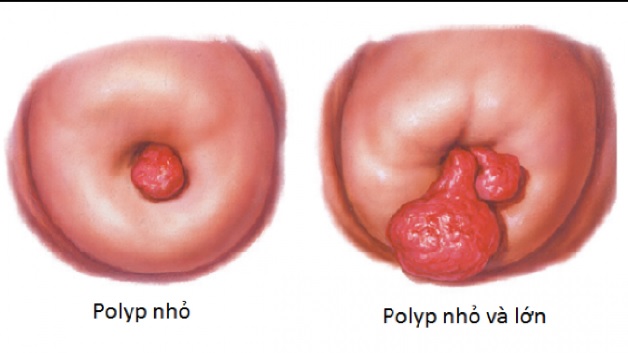 Polyp cổ tử cung là căn bệnh nhiều chị em gặp phải