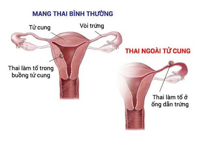 Liệu khi thai ngoài tử cung siêu âm có thấy không?