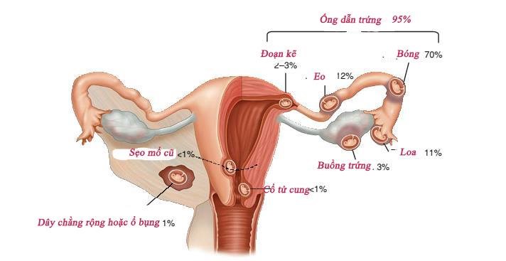 Thai ngoài tử cung có thể xuất hiện ở nhiều vị trí khác nhau, phổ biến là vòi trứng và buồng trứng