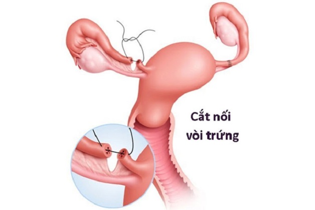 Cắt, nối ống dẫn trứng là một trong phương pháp điều trị tắc ống dẫn trứng