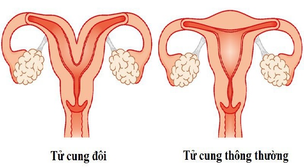 Tử cung đôi là bất thường hiếm gặp ở chị em phụ nữ