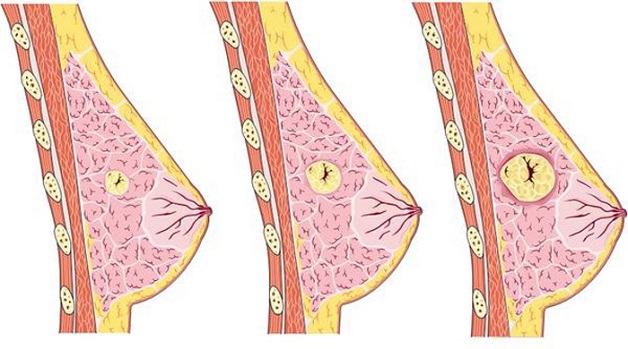 Khi bị u nang tuyến vú lành tính sẽ xuất hiện bọc dịch sâu bên trong vú