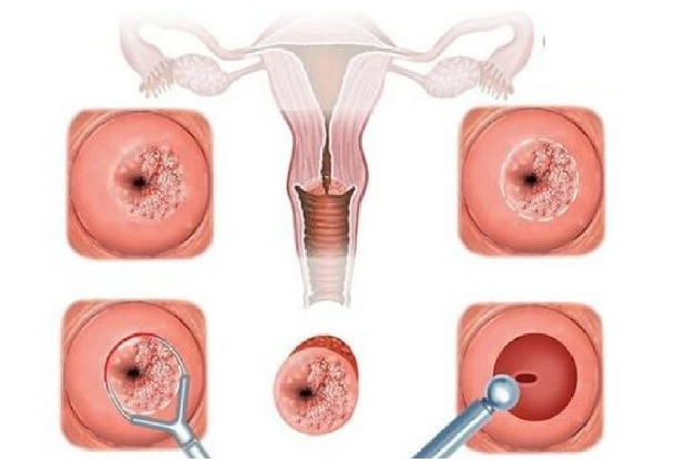 Viêm cổ tử cung là căn bệnh nhiều chị em gặp phải