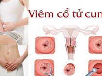 Mách mẹ cách điều trị tốt nhất viêm cổ tử cung sau sinh 