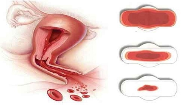 Rong kinh là một trong những dấu hiệu viêm cổ tử cung