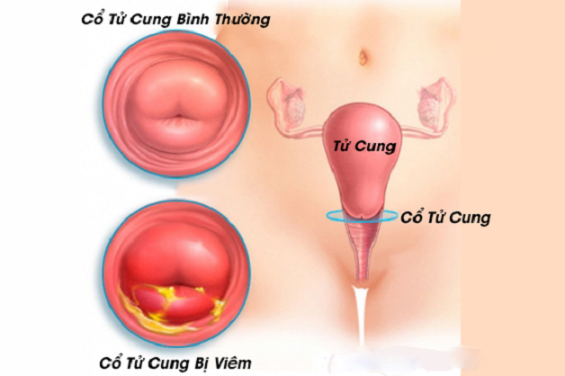 Hiện nay, rất nhiều bà mẹ bỉm sữa phải đối mặt với viêm cổ tử cung sau sinh.