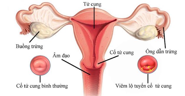 Viêm nhiễm lộ tuyến cổ ở tử cung là tình trạng mà cổ tử cung bị tổn thương do các tế bào tuyến nằm trong cổ tử cung phát triển, xâm lấn ra bề mặt ngoài tử cung