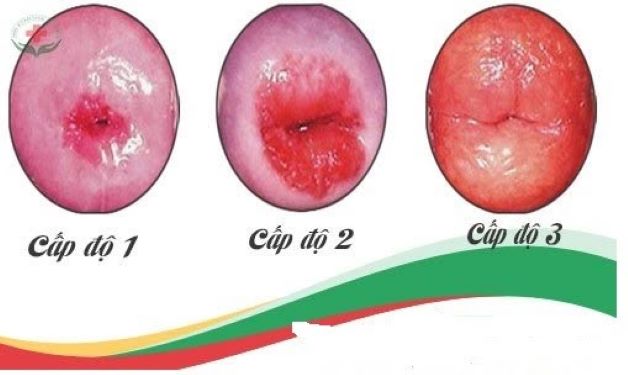 Viêm nhiễm lộ tuyến cổ tử cung được chia thành 3 cấp độ phát triển