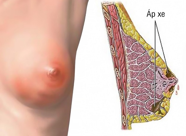 Bệnh áp xe vú là hiện tượng nhiễm khuẩn tuyến vú thường gặp ở phụ nữ.