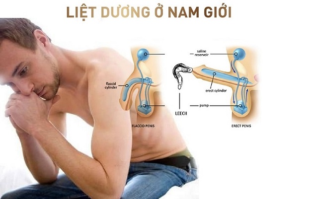 Liệt dương là gì? là câu hỏi rất nhiều đàn ông thắc mắc