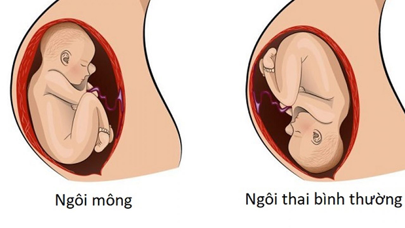 Khám thai tuần 32 giúp bác sĩ kiểm tra ngôi thai để có phương án xử lý phù hợp