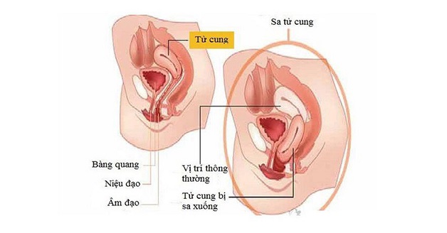 Tình trang sa tử cung có thể được can thiệp bởi phương pháp phẫu thuật