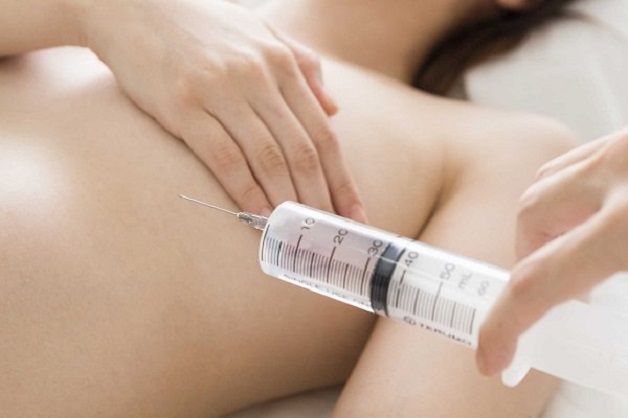 Dẫn lưu dịch là phương pháp điều trị u nang tuyến vú
