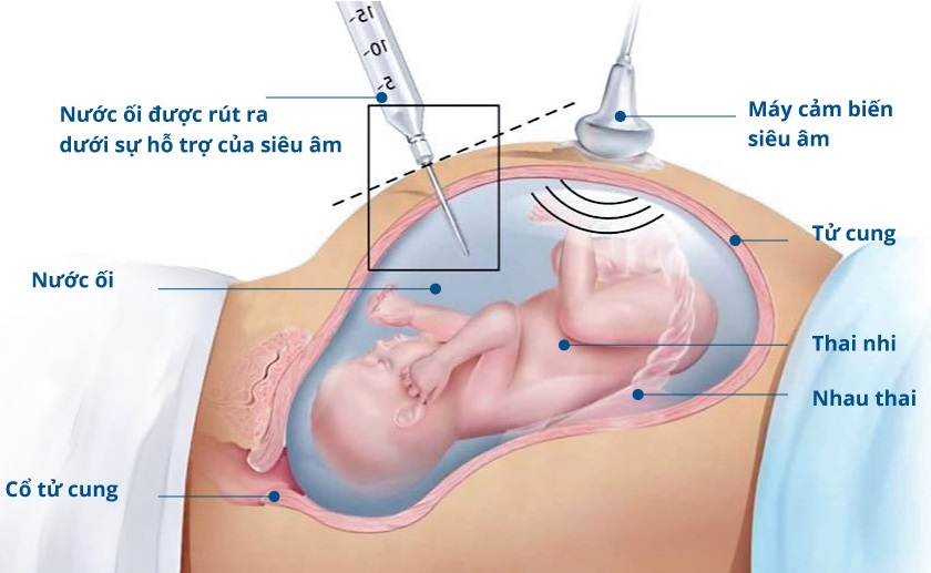 Xét nghiệm chọc ối hoàn toàn giúp bác sĩ đưa ra những chẩn đoán về nguy cơ mắc các bất thường về di truyền ở thai nhi.