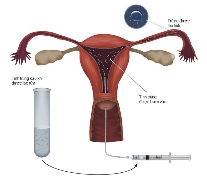 Bơm tinh trùng là một phương pháp hỗ trợ sinh sản rất phổ biến.