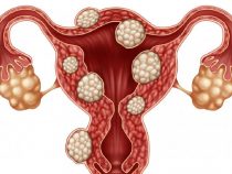 Nhân xơ tử cung là như thế nào? Dấu hiệu, tác hại và cách điều trị