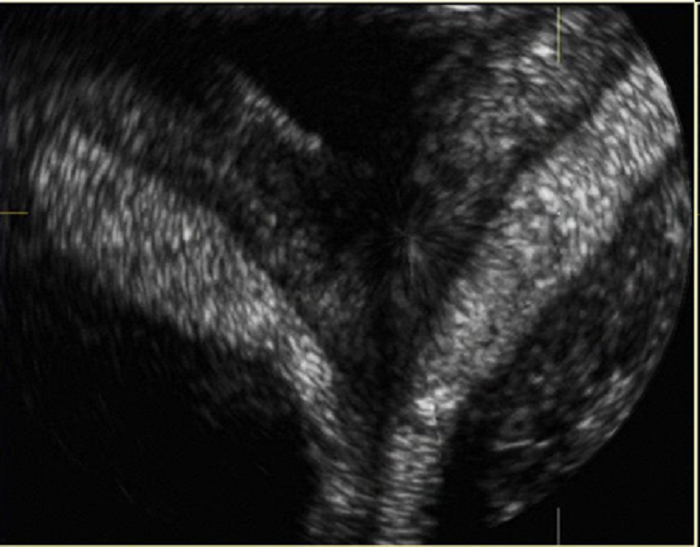 Hình ảnh tử cung đôi thông qua siêu âm