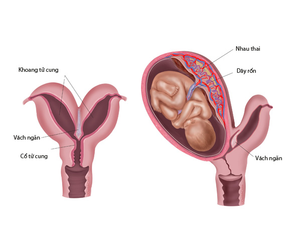 Một trường hợp mang thai của mẹ có tử cung đôi