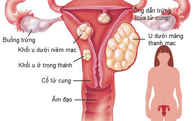 U xơ tử cung có thể xuất hiện tại những vị trí khác nhau