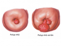 Polyp cổ tử cung: Nguyên nhân, triệu chứng và điều trị