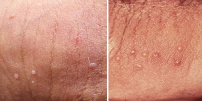 Biểu hiện sùi mào gà ở nam giới giai đoạn dầu