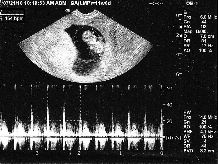 Khi được bác sĩ kết luận là tim thai dương tính tức là thai nhi đã có tim thai. tim thai dương tính là sao