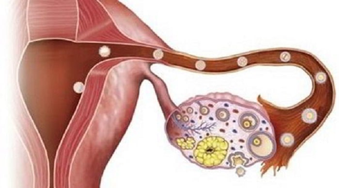 U nang bì buồng trứng, đây là một loại u nang có nguồn gốc từ các tế bào mầm