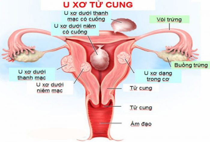 U xơ tử cung là một căn bệnh lành tính khá phổ biến ở nữ giới
