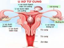 Mổ u xơ tử cung nằm viện bao lâu?