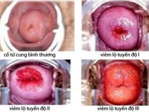 chữa trị viêm lộ tuyến cổ tử cung bằng đốt điện