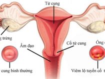 Cách trị viêm lộ tuyến cổ tử cung hữu hiệu nhất