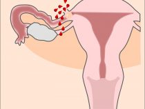 Mang thai ngoài tử cung có kinh nguyệt không