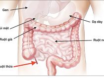 Mổ ruột thừa có mang thai được không?