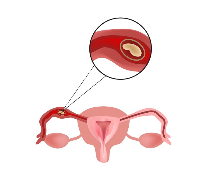 Có 2 phương pháp điều trị thai ngoài tử cung là dùng thuốc và phẫu thuật.