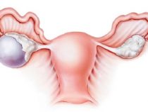 Dấu hiệu và cách điều trị chứng bệnh u nang buồng trứng trái
