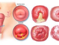 Đốt điện cổ tử cung có tác động gì không?