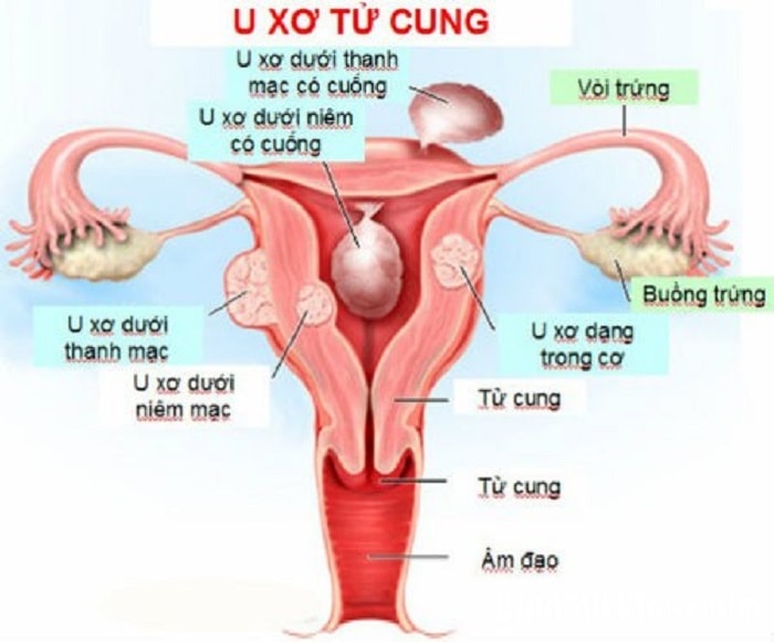 Viêm cổ tử cung là bệnh không hiếm gặp