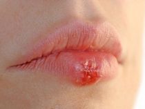 chứng bệnh tình dục ở miệng và những nguy hiểm tiềm ẩn
