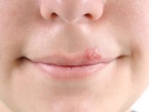 Cảnh báo các chứng bệnh truyền nhiễm qua đường tình dục thường gặp hiện nay