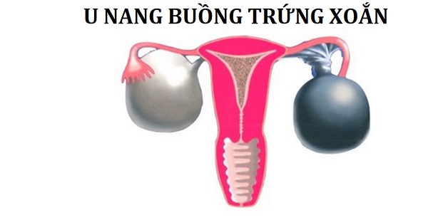 Khi u nang buồng trứng xoắn nên phẫu thuật cắt bỏ khối u